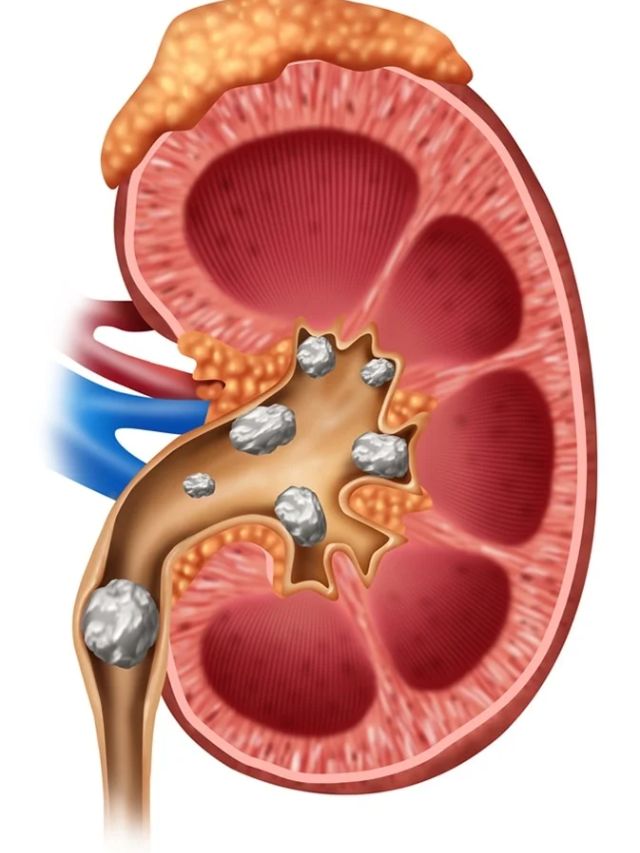 Kidney Stones