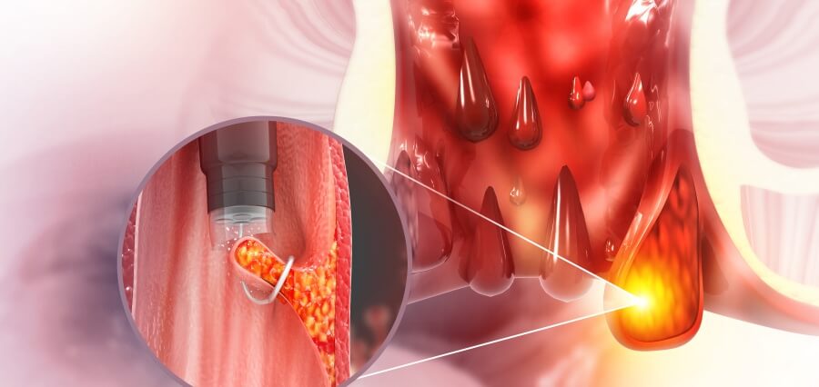 Hemorrhoids