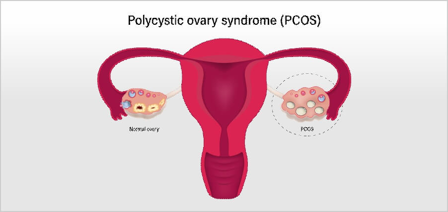 PCOS