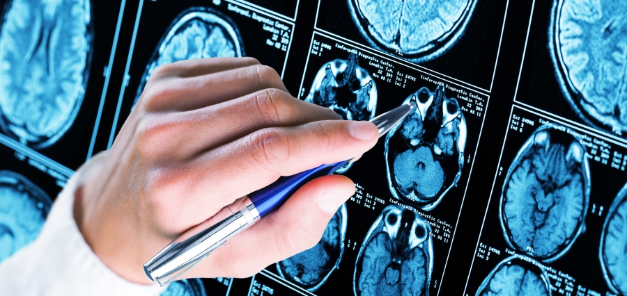 UK Researchers Launch Simple Blood Test to Transform Alzheimer’s Diagnosis in Europe